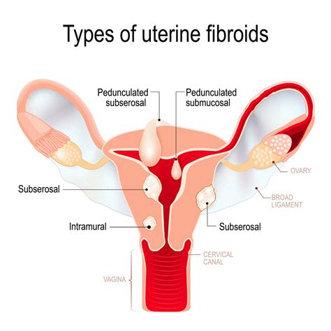 Uterine Fibroids International Womens Clinic