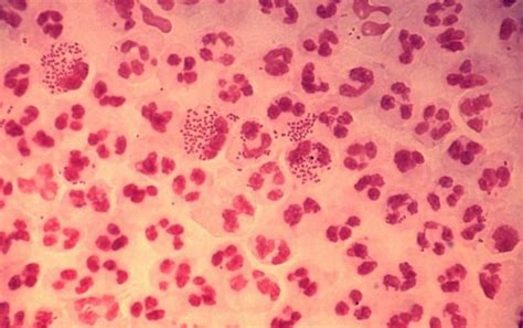Safe Sex Gonorrhea Becoming Resistant To Only Treatment