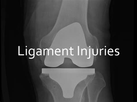 ligament injury  symptoms treatment canberra
