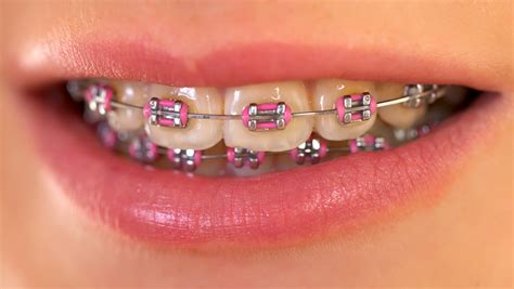 pink braces smilecentre