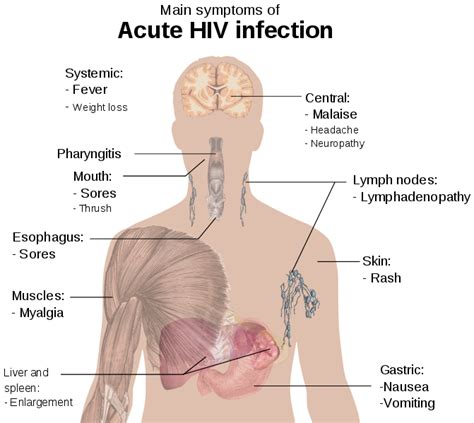 File Symptoms Of Acute Hiv Infection Svg Wikimedia Commons