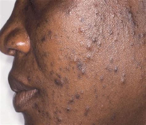 pimples acne  symptoms treatment diagnosis  prevention