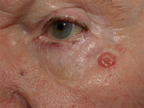 skin cancer basal cell cancer  melanoma malignant melanoma