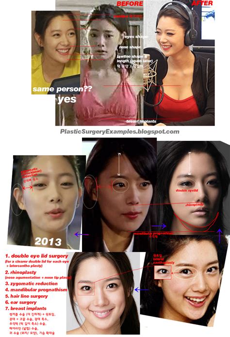 Plastic Surgery Examples Clara Lee Korean Actress Plastic