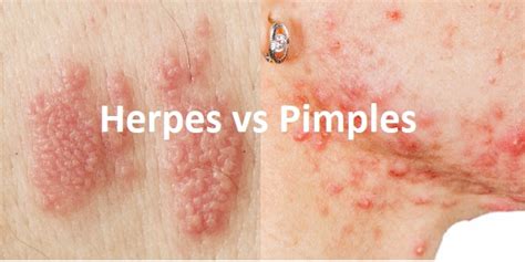 herpes vs razor bumps herpes vs razor bumps