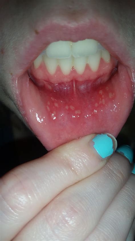Is It Normal To Get This Many Canker Sores Over Night