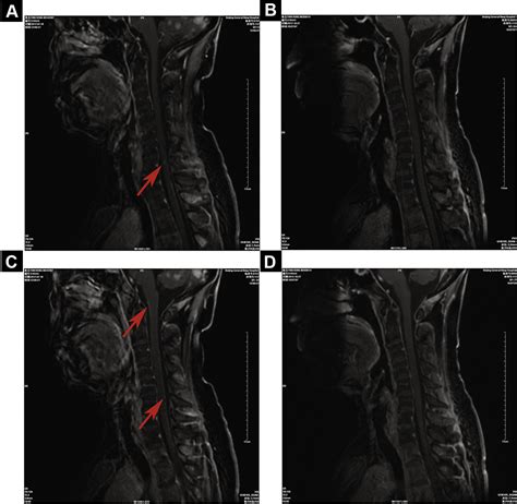 Erlotinib For Progressive Brain And Leptomeningeal Metastases From Her2