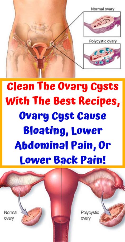 Let Start Slim Today Clean The Ovary Cysts With The Best Recipes