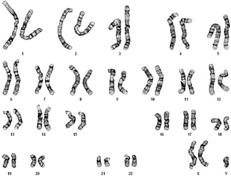 A Karyotype Of 47 Xxy Download Scientific Diagram