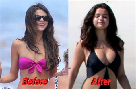 Selena Gomez Nose Job Plastic Surgery Really