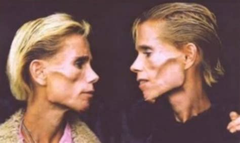 famous anorexic identical twins die  house fire  prophecy   die
