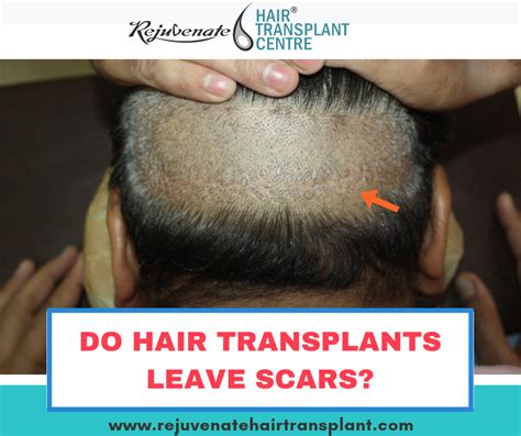 hair transplants leave scars rejuvenate hair