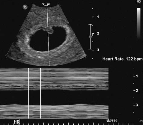 ultrasound series part  heartbeat crossroads pregnancy center