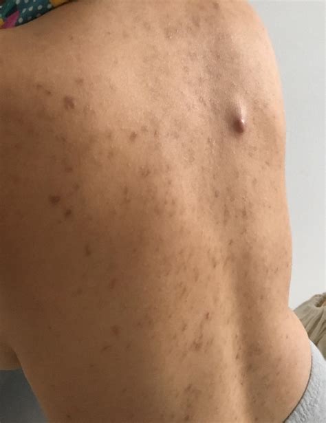 [skin concerns] i ve had acne on my back for 5 6 years now these are