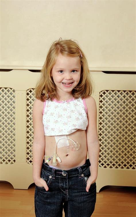 young girl  gastric feeding tube photograph  science photo library