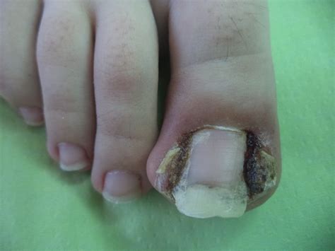 urasli nokti uzroci simptomi  metode tretiranja  foot clinic