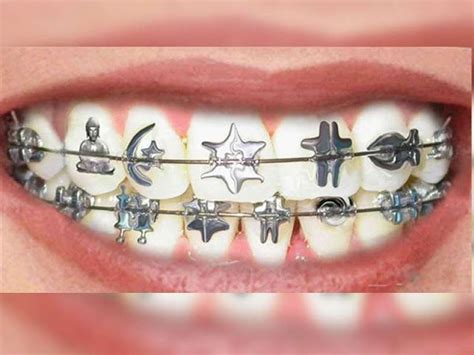 10 estilos de brackets que están muy de moda ¡elegí tu