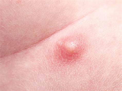 pimple on stomach causes treatment and prevention