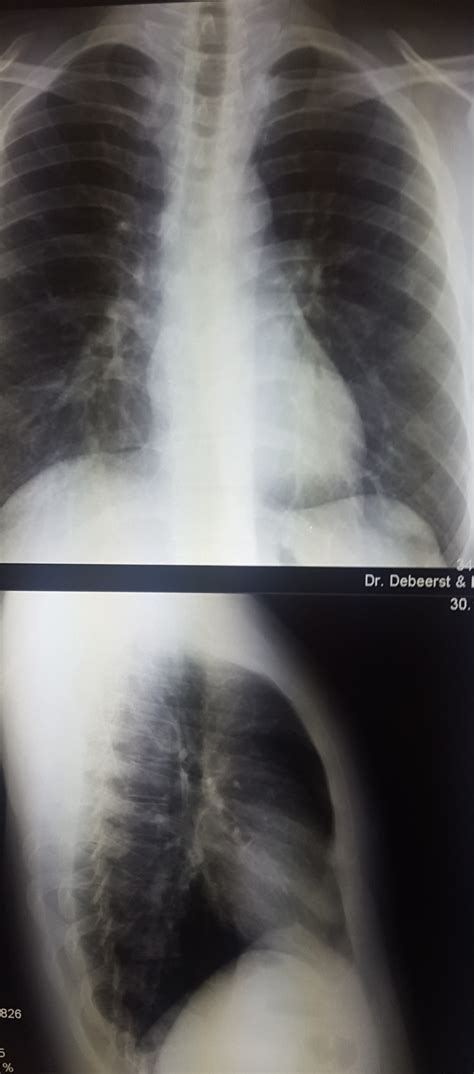 roentgen thorax bild alles  ordnung gesundheit und medizin