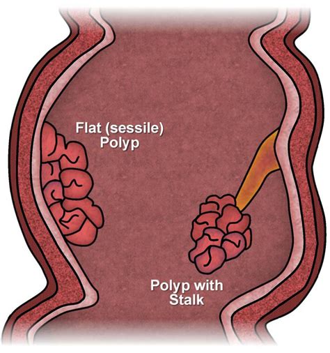 pólipos del colon y el recto ascrs