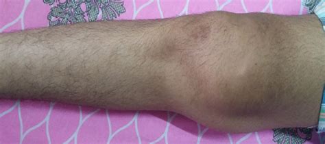 swelling of fluid behind knee