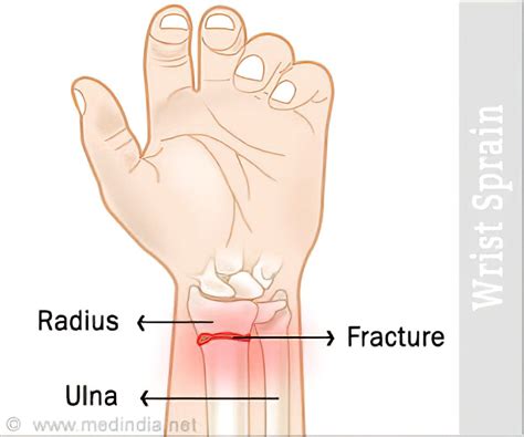 wrist sprain  symptoms diagnosis treatment