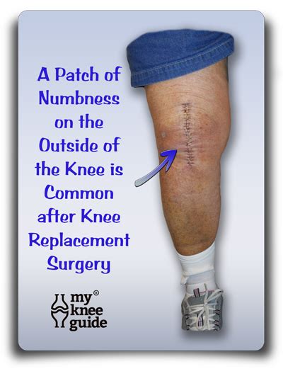 Knee Numbness A Common Post Operative Finding My Knee