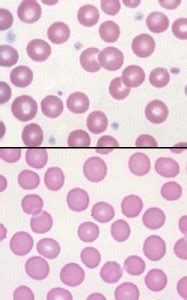 normal  abnormal platelet count eclinpath