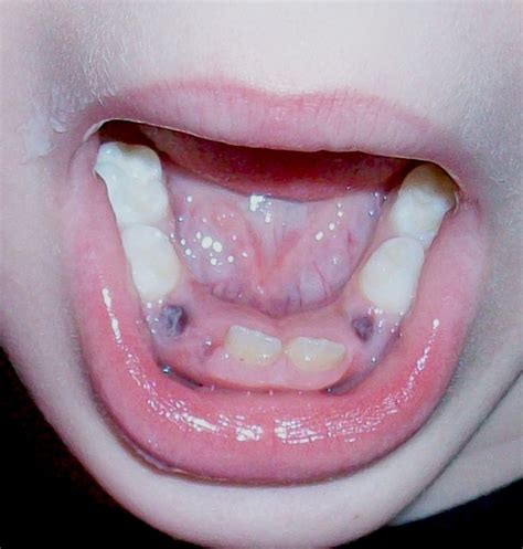 young child  teeth pulled healdove