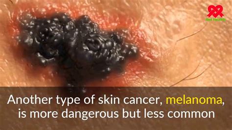 Skin Cancer Symptoms – Causes Symptoms And Pictures Of Melanoma Skin