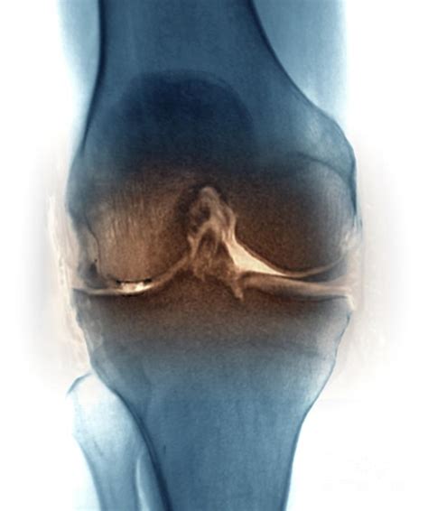 osteoarthritis   knee joint photograph  zephyrscience photo library pixels