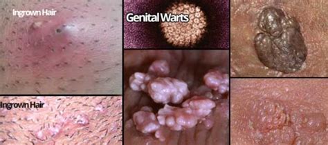 Ingrown Hair On Female Privy Area Prevent Treat And Home