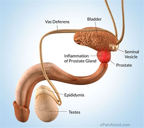 Prostate Pain Classification Types Etiology Risk Factors