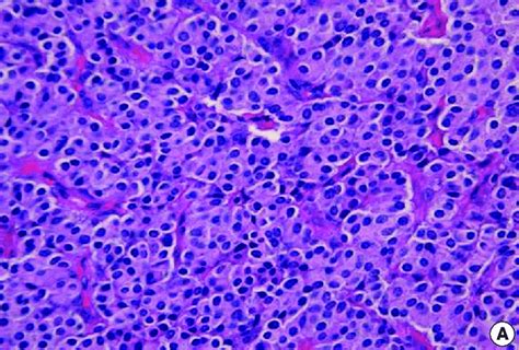Representative Histologic Features Of Pulmonary Carcinoid Tumors A