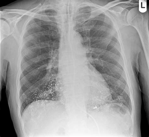 aspirated barium swallow image