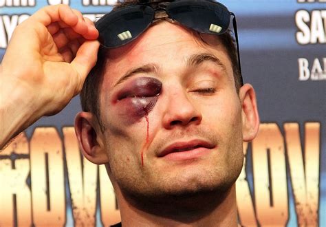 The 10 Worst Black Eyes Of All Time