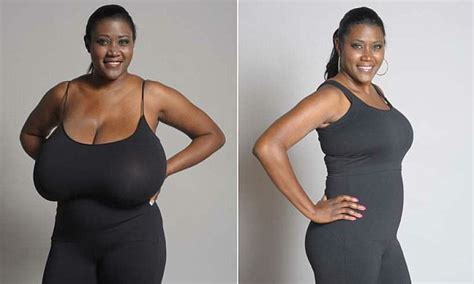 Kerisha Mark With 36nnn Breasts Has 15lbs Of Tissue
