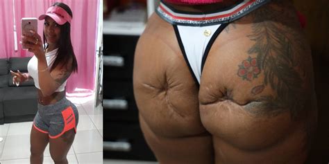 this brazilian woman is left disfigured with crater like scars after