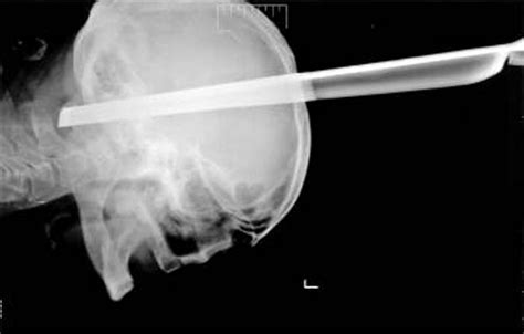 x ray shows man with metal stool leg through brain in