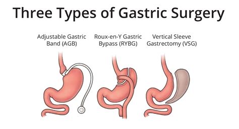 Which Bariatric Procedure Is Right For Me The Bariatric