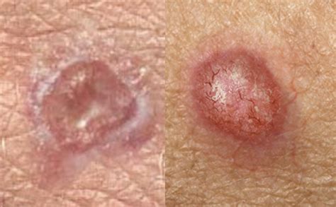 main type  skin cancer  differences histology  prevention andreas astier