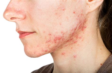 A New Vaccine Could Wipe Out Acne