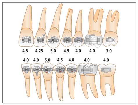 principle  build treatment  bracket placement pocket dentistry