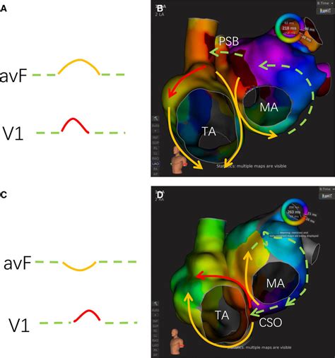 Flutter Wave Morphology Of Peri Mitral Atrial Flutters Is Mainly