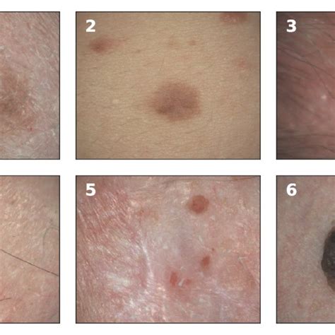 skin cancer examples