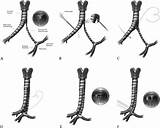 Stenosis Congenital Tracheobronchial Reconstruct Complex sketch template