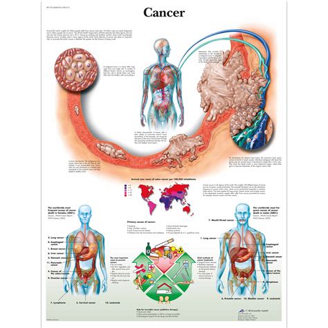anatomical charts  posters anatomy charts pathology charts cancer paper chart