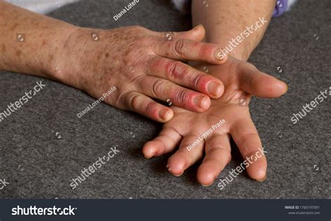 hands woman raynauds syndrome swollen reddened shutterstock