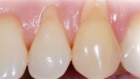 es la abrasion dental causas  tratamiento ccm dental