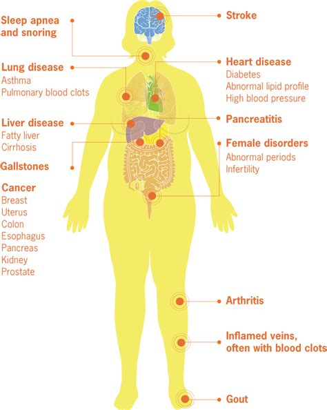 Medical Complications Of Obesity Vitalsigns Cdc